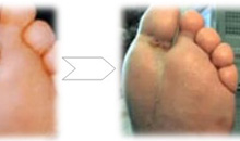 HBOT For Diabetic Foot: Hint Of Benefit For Wound Closure