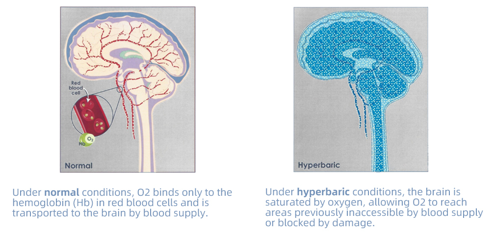 hyperbaric_chamber_for_stroke_recovery.png