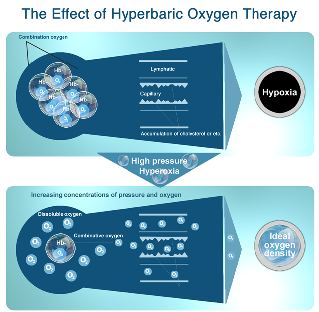 hyperbaric_oxygen_therapy_chamber_for_sale.png