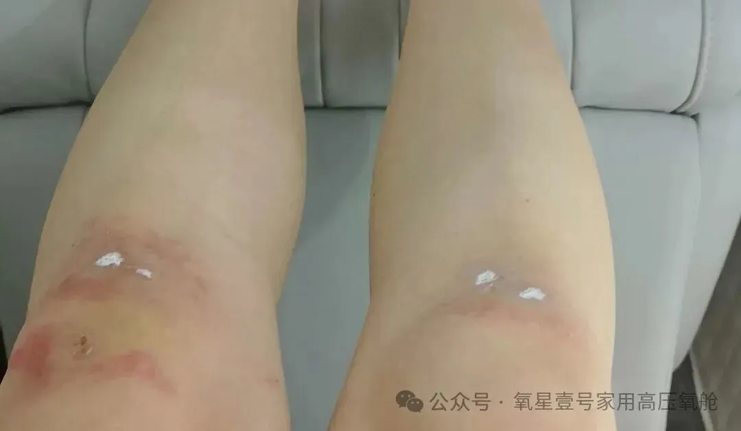 HBOT swelling reduction-1112.jpg HBOT swelling reduction-1112.jpg